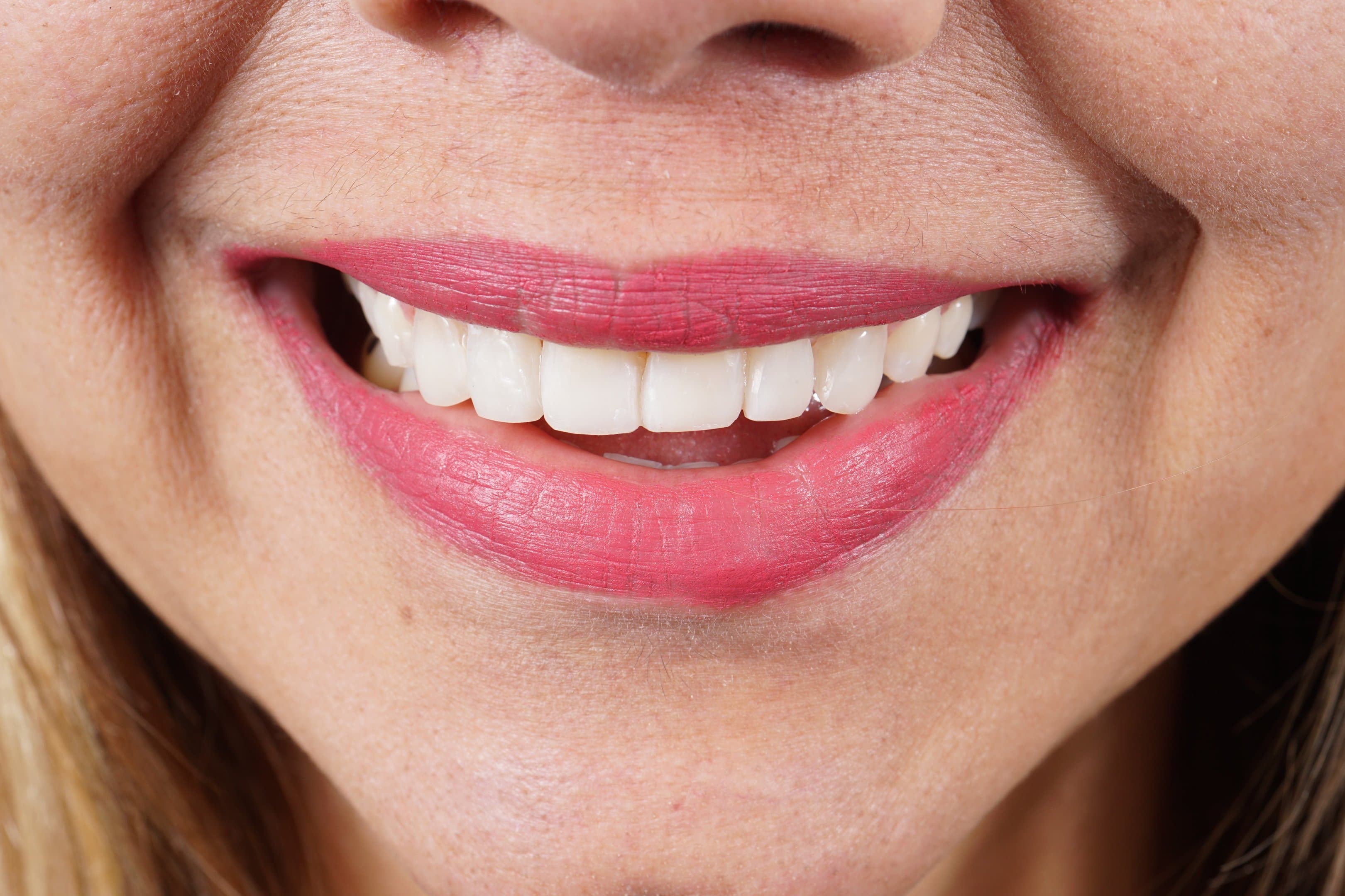 Blanqueamiento Dental en Consulta
