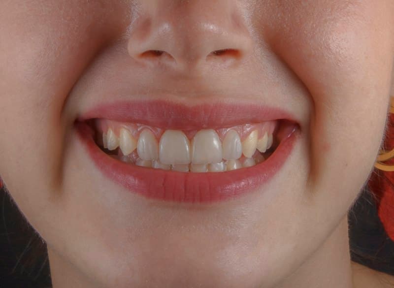 Diseño de Sonrisa